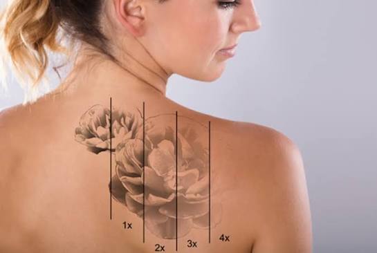 Effective Tattoo Removal Services: How Evolution Laser Clinic Transforms Your Skin